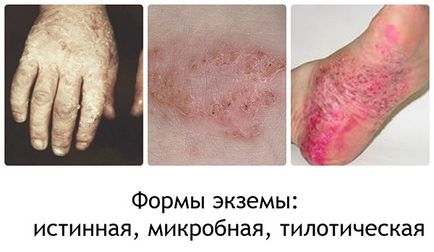Eczeme pe picioare cauze, simptome, imagini, metode de tratament și remedii populare
