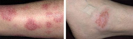 Eczeme pe picioare cauze, simptome, imagini, metode de tratament și remedii populare