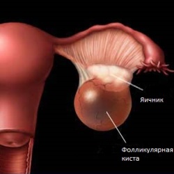 remedii foliculare ovariene populare de tratament chisturi