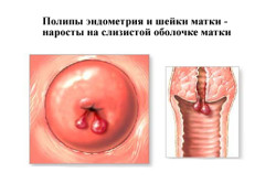 incluziuni hiperecogene în uter