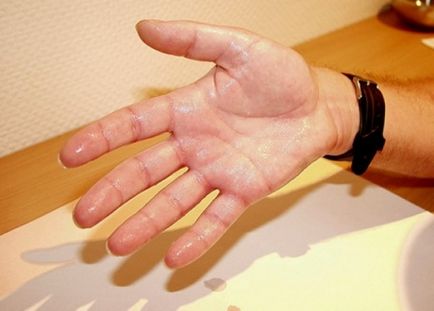 Hiperhidroză palmelor cauze, simptome, tratament