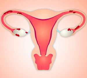 tratamente hormonale pentru endometrioza 2