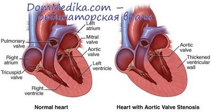 gradienți de presiune în stenoza aortica