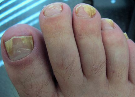 leziuni ale pielii micotice - fotografie arata ca o boala, o ciuperca pe corp, cuiele pe mâinile sale