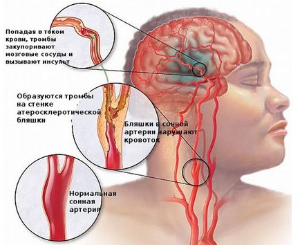 Accident vascular cerebral efectele secundare potrivite ca viu ischemică, hemoragic, dreapta
