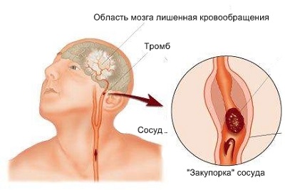 accident vascular cerebral simptome, simptome la femei și bărbați, efectele