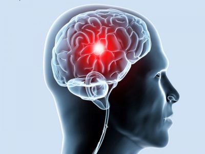 Ischemia a vaselor creierului la adult ceea ce este, gradul de simptome și tratamentul bolii