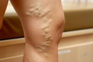 Cum și ce pentru tratarea venelor varicoase grele pe picioare de femei și bărbați fără o intervenție chirurgicală