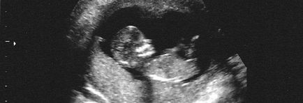 Cum și când se poate determina sexul unui copil nenăscut cu ultrasunete