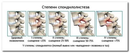 Cum de a trata vertebre lombare deplasare
