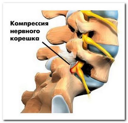 Cum de a trata vertebre lombare deplasare