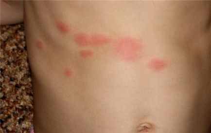 Cum alergii ale pielii, pete roșii și tratarea acestora