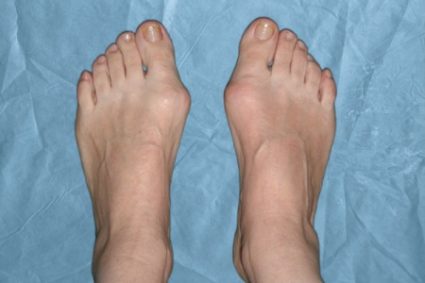 Cum de a elimina os și tratamente populare tradiționale picior