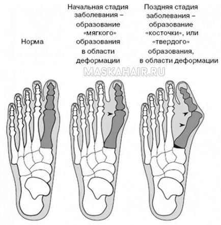 Cum de a elimina mici umflături pe picioarele degetul mare, fără o intervenție chirurgicală sau o fotografie chirurgical