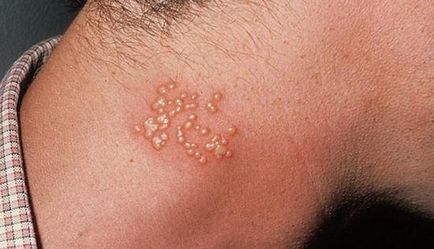 Ce este herpesul fotografie corpului uman, cauzele de