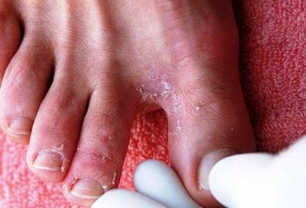 Cum de a vindeca ciuperca intre degetele de la picioare rapid remedii populare