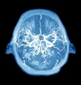 cavernoma creierului (angiom cavernos și hemangiom), ceea ce este, consecințele tratamentului