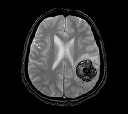 cauze, simptome, diagnostic, tratamente, efecte cavernoma creierului