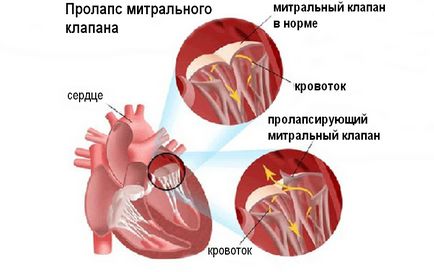 supapa de inima nu se închide până la sfârșitul anului - cauze si simptome