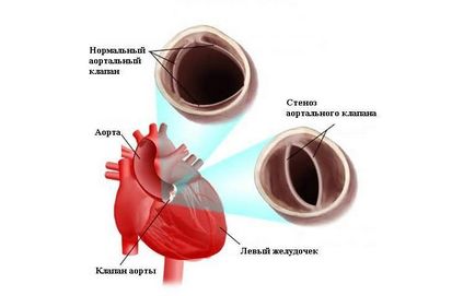 supapa de inima nu se închide până la sfârșitul anului - cauze si simptome