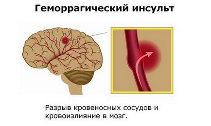 Coma în accident vascular cerebral hemoragic