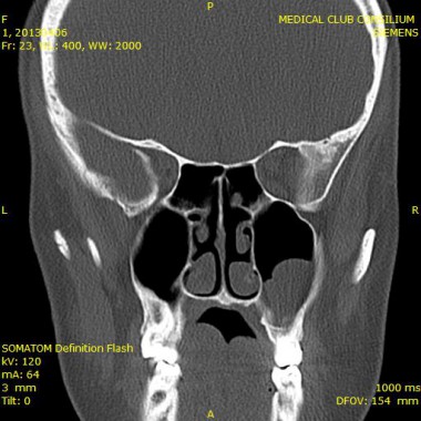 Tomografia computerizată (CT) a sinusurilor paranazale - care arată