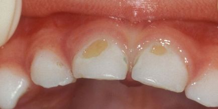 Brown placa pe dinti - cum se elimina în siguranță pete întunecate în casă