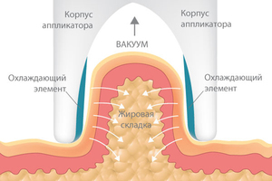 Cryolipolysis cum funcționează această metodă, utilizarea acestei proceduri în salon și la domiciliu,