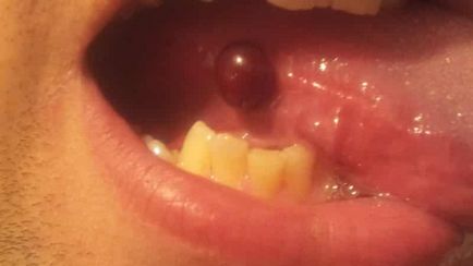 blister sânge pe imagine limba si modul de a trata blistere