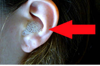 urechi și ciuperca la om Tratament de cerumen