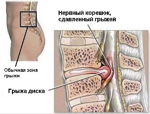 tratamentul coloanei vertebrale și a articulațiilor