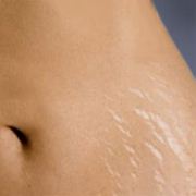 Tratamentul vergeturi (striuri) pe piele, precum și ceea ce poate fi vindecat