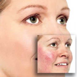 Persoanele cu pielea extrem de sensibilă cauzează probleme