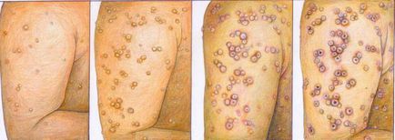 Natural sau variola, care este și modul în care să se manifeste