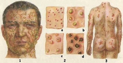 Natural sau variola, care este și modul în care să se manifeste