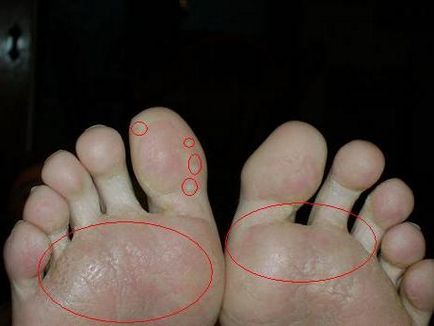 Mai multe modalități de a face cu fenomenul de mici umflături pe degetele de la picioare