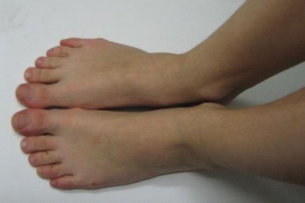 Mai multe modalități de a face cu fenomenul de mici umflături pe degetele de la picioare