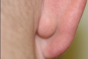 Șirag de mărgele formate pe cauzele lobul urechii si tratament