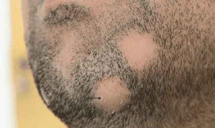 Alopecia areata Tratamentul de masculi de reproducere chelie