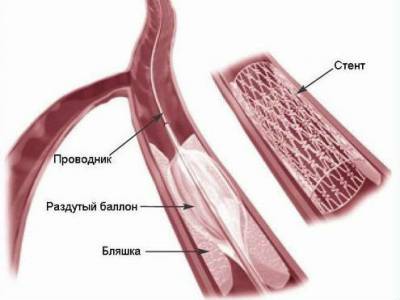 Ocluzia arterelor membrelor inferioare (femurală, poplitee) și tratamentul acesteia