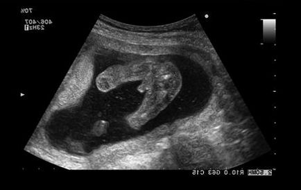 Determinarea sexul copilului pe ultrasunete 20 de săptămâni, probabilitatea de eroare, fotografie, 3d