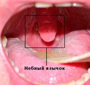 umflarea gâtului la adulți și copii cauzele și consecințele