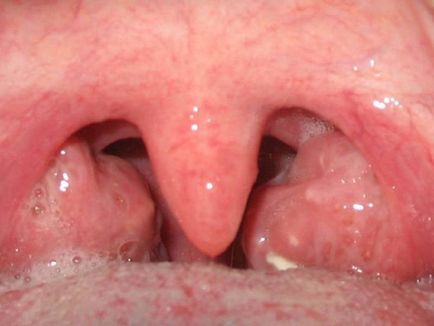 umflarea gâtului la adulți și copii cauzele și consecințele