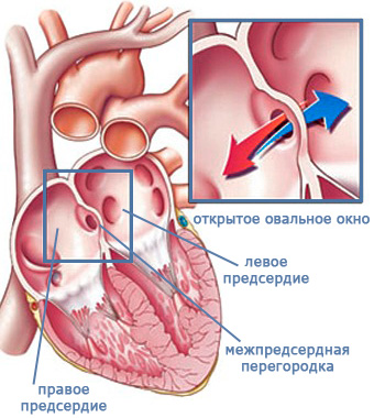 brevet foramen ovale în inima unui copil