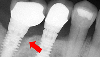 Dinte implant simptome de respingere și cauzele