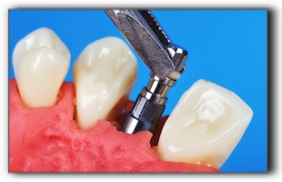 Dinte implant simptome de respingere și cauzele