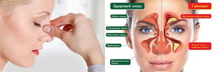 Pansinusitis ce este, simptome, tratament si tipuri