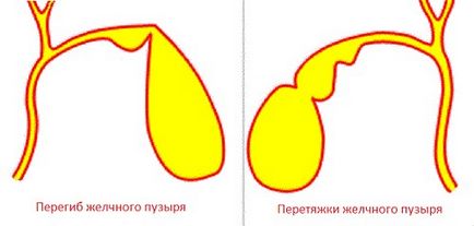 Căptușeala vezicii biliare cauze, simptome, tratament