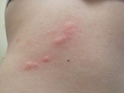 Apariția unor pete roșii pe piele cauzele și tratamentul alergiilor, pete pruriginoase de ce, fotografii