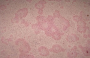 Apariția unor pete roșii pe piele cauzele și tratamentul alergiilor, pete pruriginoase de ce, fotografii